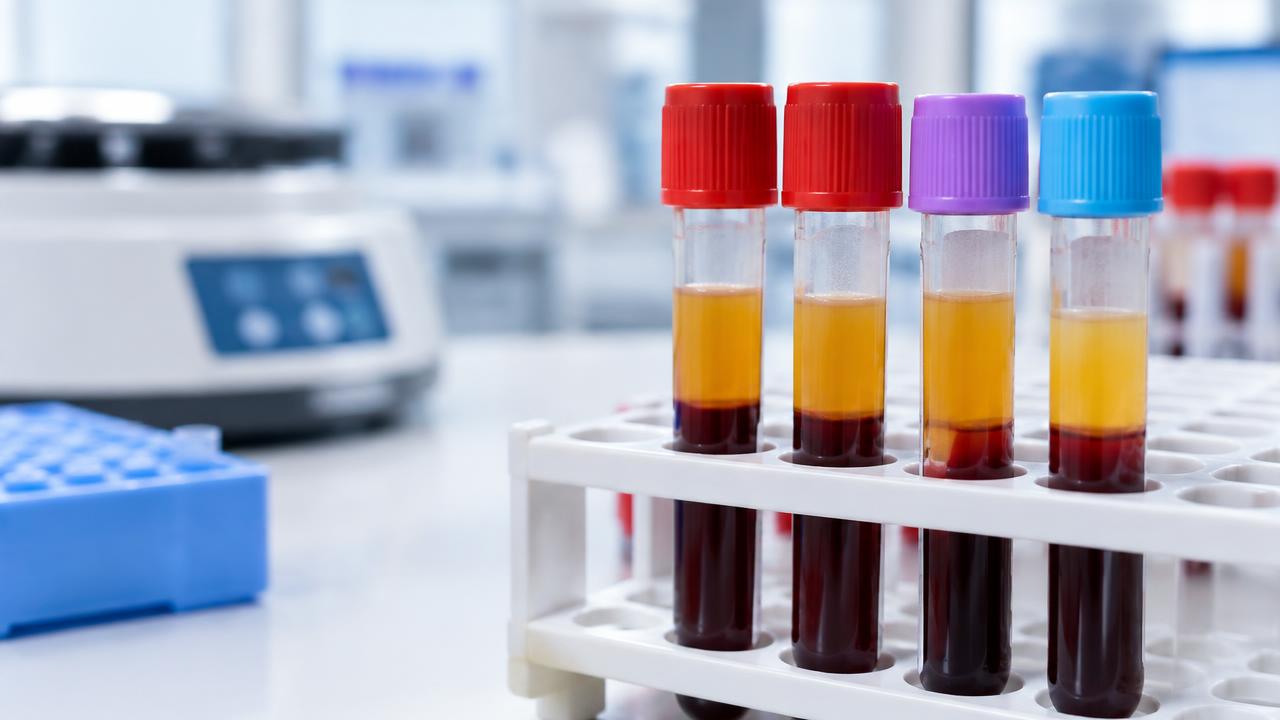 Tubos con muestras de sangre en un laboratorio, preparados para medir colesterol y triglicéridos.